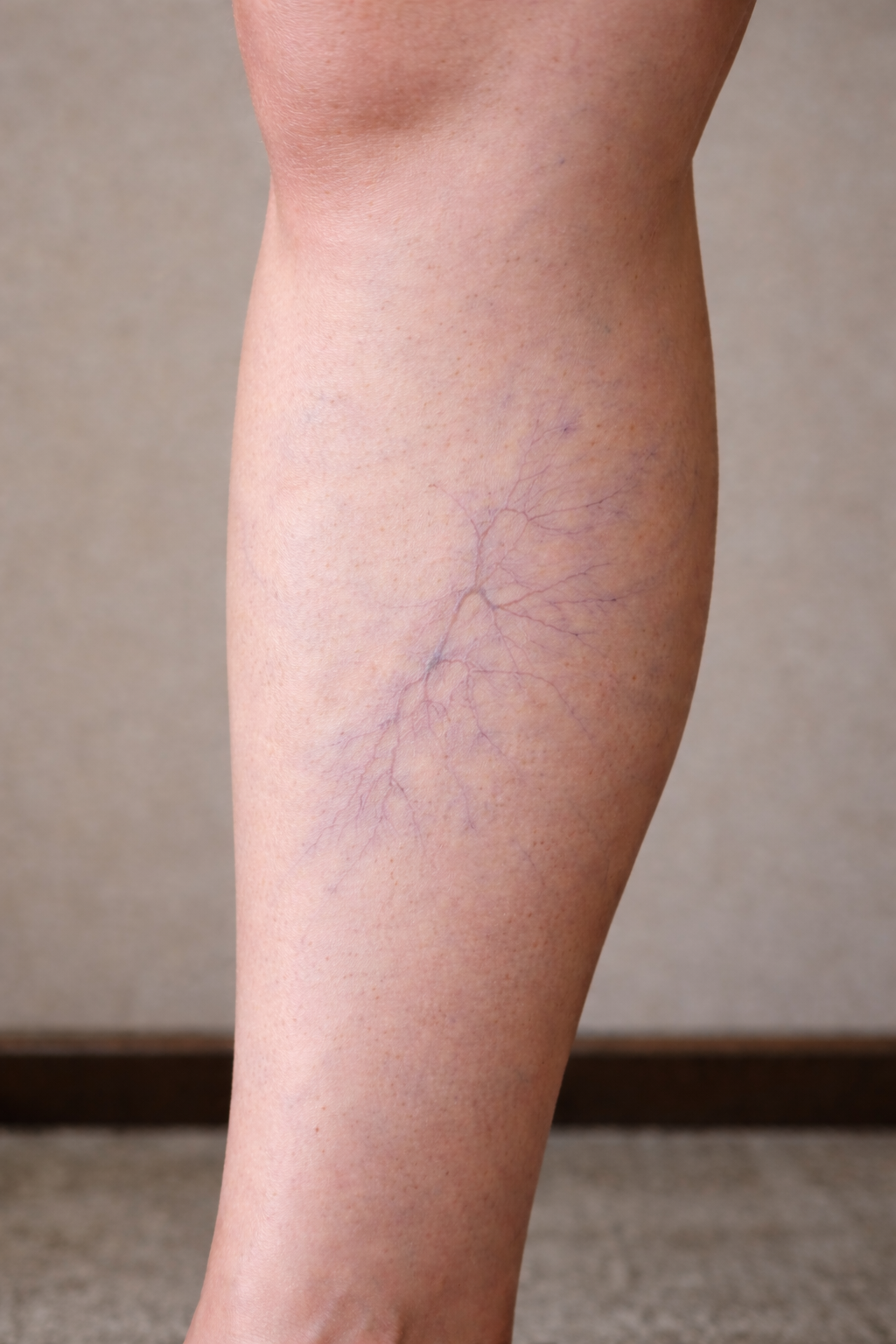 Spider Veins
